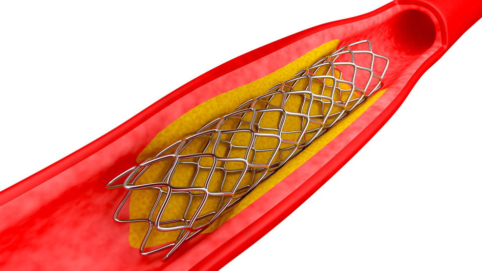 ¿Que son los Stent?